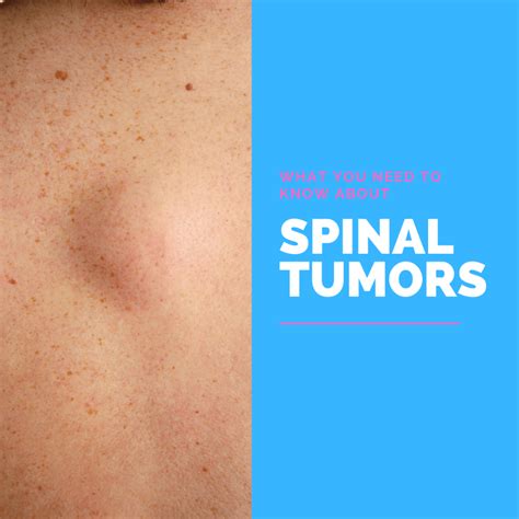 Tumor on Back of Neck: A Comprehensive Guide