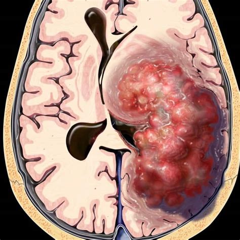 Tumores cerebrais: