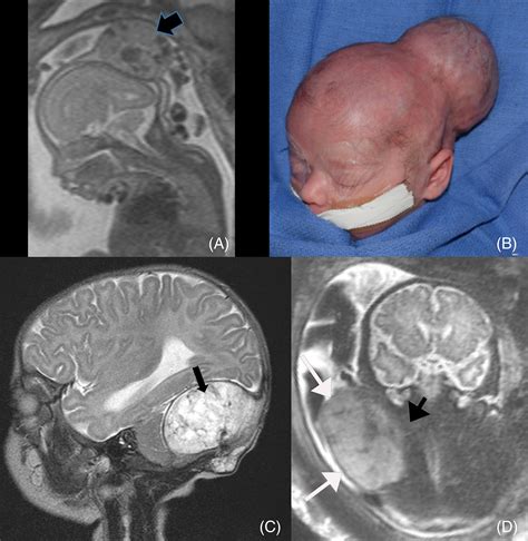 Tumors of the Fetus and Newborn Doc