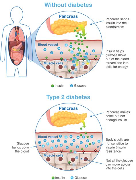 Type 2 Diabetes Explained A Guide for Patients and Carers PDF