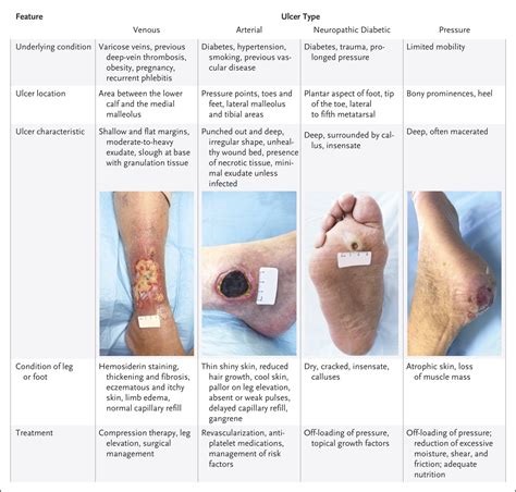 Type of ulcer: