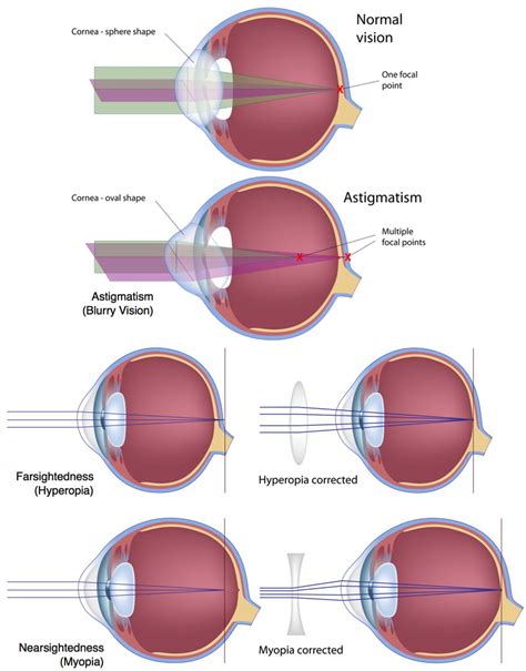 Type of vision correction: