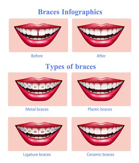 Types of Braces