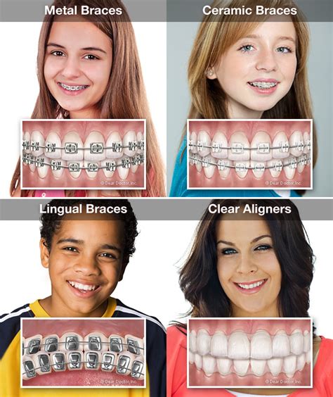 Types of Braces and Their Costs