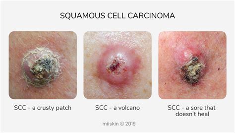 Types of Cancerous Bumps