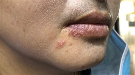 Types of Fungal Infections on Face