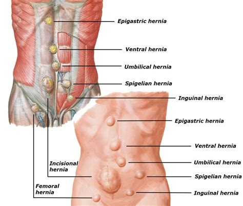 Types of Inguinal Hernias: