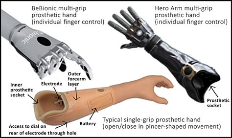 Types of Prosthetic Arms