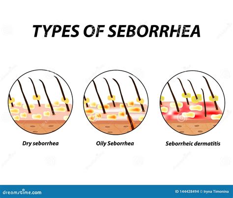 Types of Seborrhea