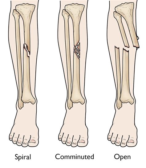 Types of Shin Fractures