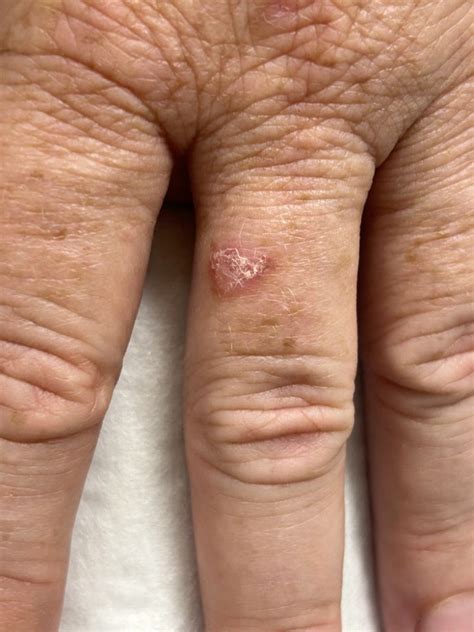 Types of Skin Cancer on the Finger