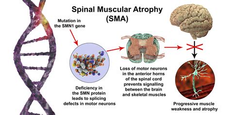 Types of Spinal Muscular Atrophy