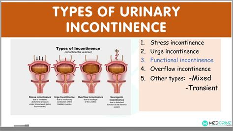 Types of Urinary Incontinence