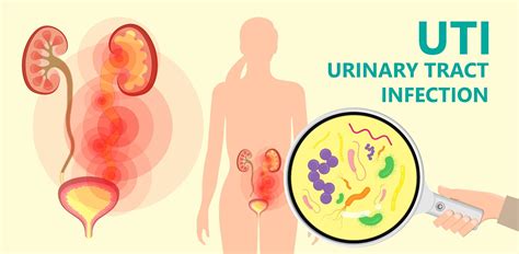 Uncomplicated urinary tract infections (UTIs)