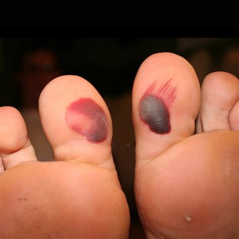 Understanding Blood Blisters on the Bottom of Foot