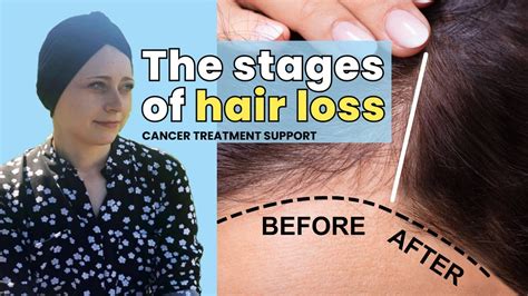 Understanding Cancer and Hair Loss