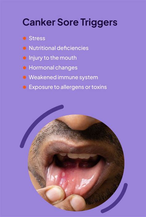 Understanding Canker Sores from Zyn