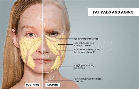 Understanding Chubby Faces: Key Considerations