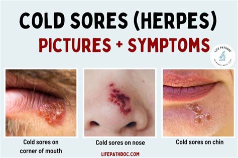 Understanding Cold Sores: A Herpes Simplex Virus (HSV) Conundrum