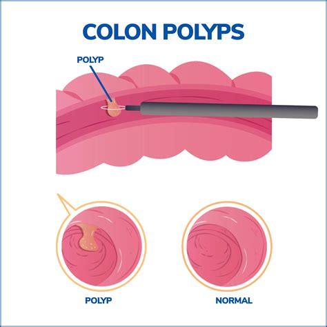 Understanding Colon Conversion