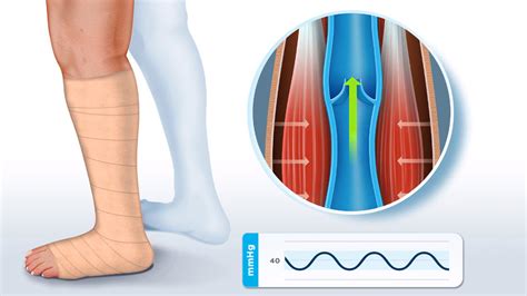 Understanding Compression Therapy