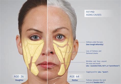 Understanding Facial Aging