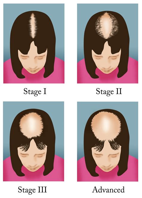 Understanding Female Pattern Hair Loss: The Numbers Don't Lie