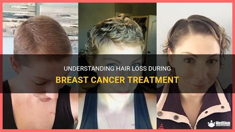 Understanding Hair Loss During Cancer Treatment