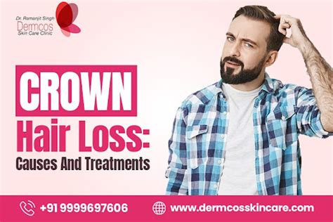 Understanding Hair Loss on the Crown