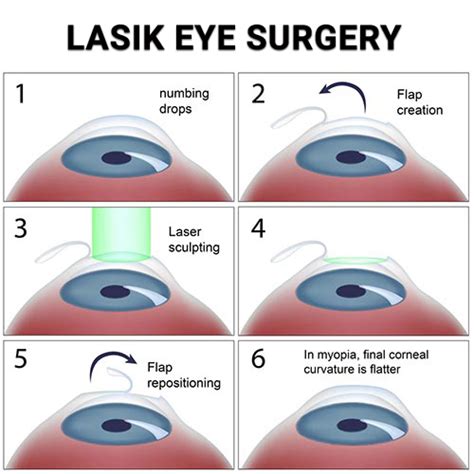 Understanding Lasik Treatment