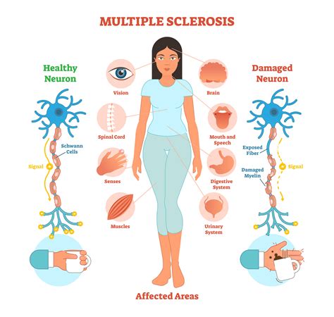 Understanding Multiple Sclerosis (MS)