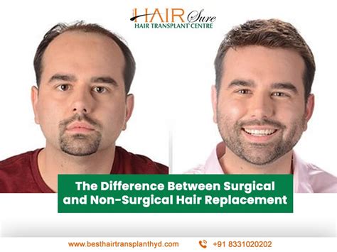 Understanding Non-Surgical Hair Replacement