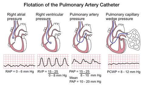 Understanding PA Pressure