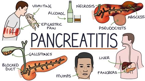 Understanding Pancreatitis