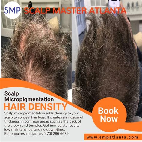 Understanding Scalp Density