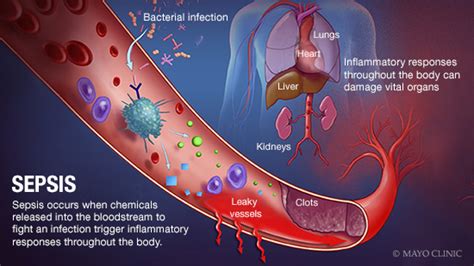 Understanding Sepsis