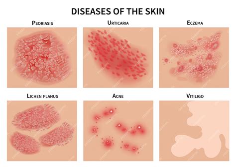 Understanding Skin Problems: Acne, Eczema, Psoriasis and Related Conditions Epub