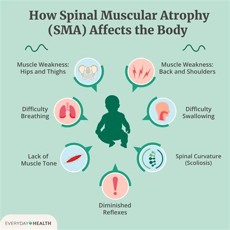 Understanding Spinal Muscular Atrophy (SMA)