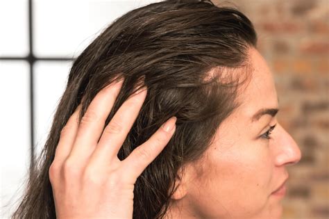 Understanding Thinning Hair Temples