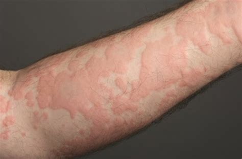 Understanding Transient Urticaria