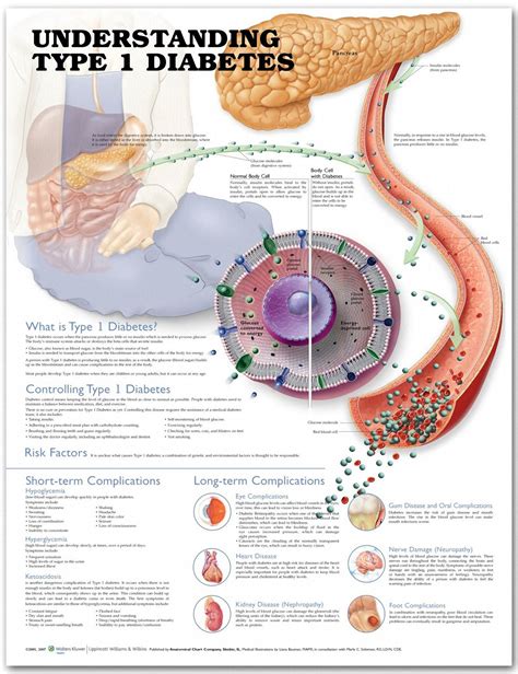 Understanding Type 1 Diabetes