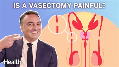 Understanding Vasectomy