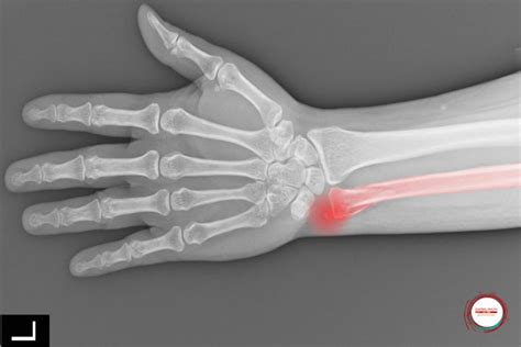 Understanding Wrist Anatomy and Injuries