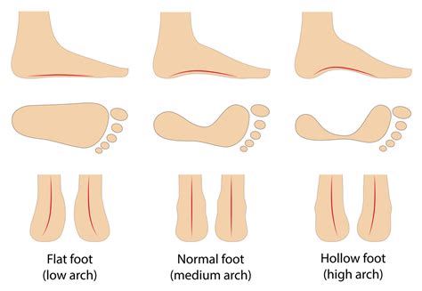 Understanding Your Foot Type and Arch Height