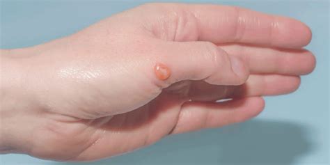 Understanding and Treating Blisters on the Pinky Toe: A Comprehensive Guide