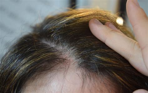 Understanding the Causes of Thinning Hair