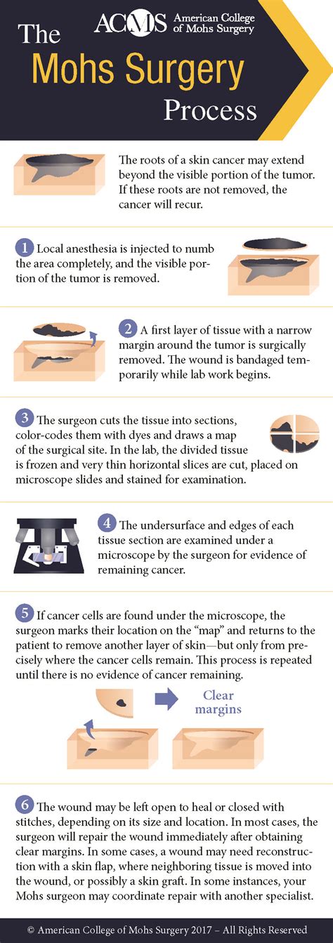 Understanding the Mohs Table of Surgical Procedures