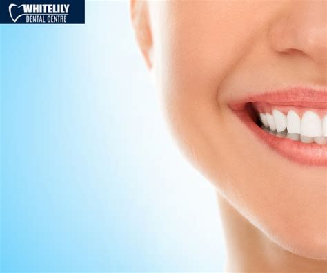 Understanding the Science of Teeth Whitening