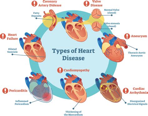 Understanding the Spectrum of Heart Disease