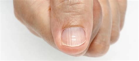 Unhas com Manchas Brancas: Causas, Tratamentos e Prevenção